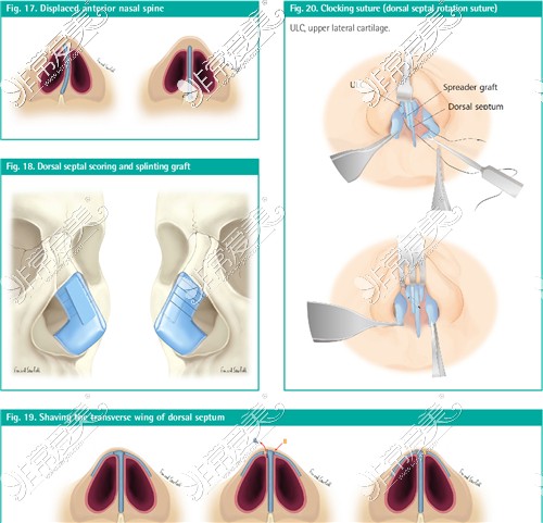歪鼻矫正手术图示