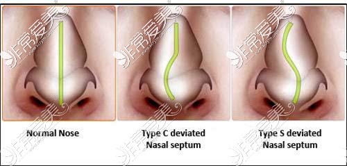 歪鼻矫正手术