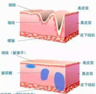 额头抬头纹_额头抬头纹_额头上的抬头纹怎么办